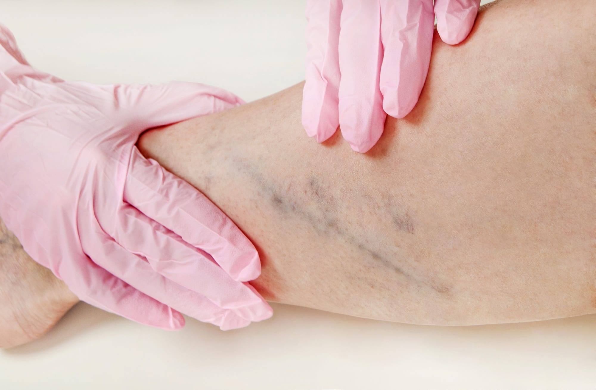 Examination of varicose veins on the womans legs