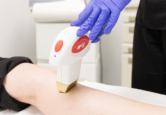 ipl-treatments