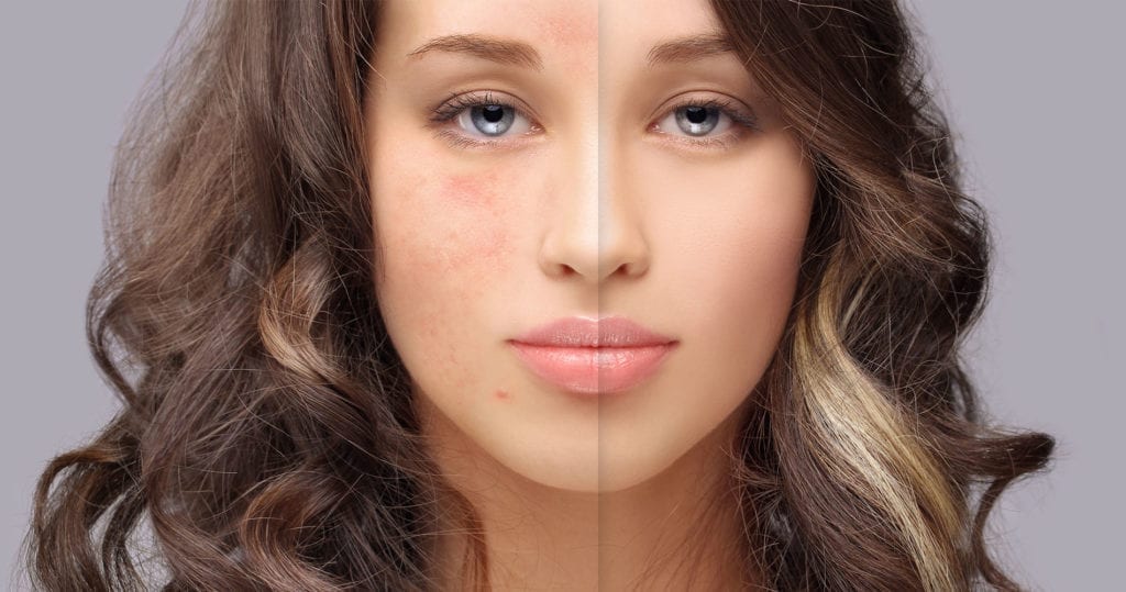 rosacea awareness month