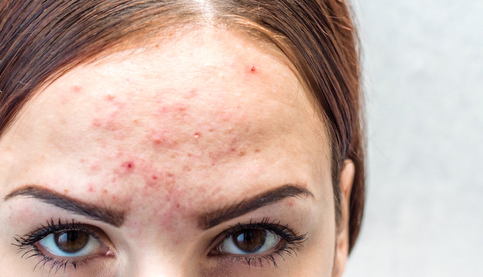 acne treatment