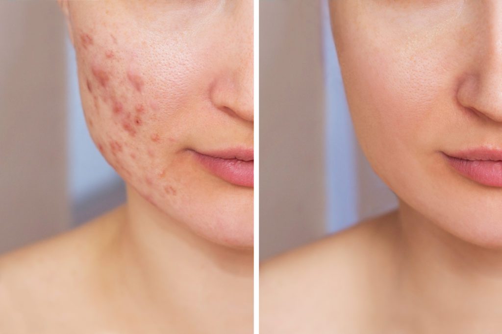 before and after acne treatment