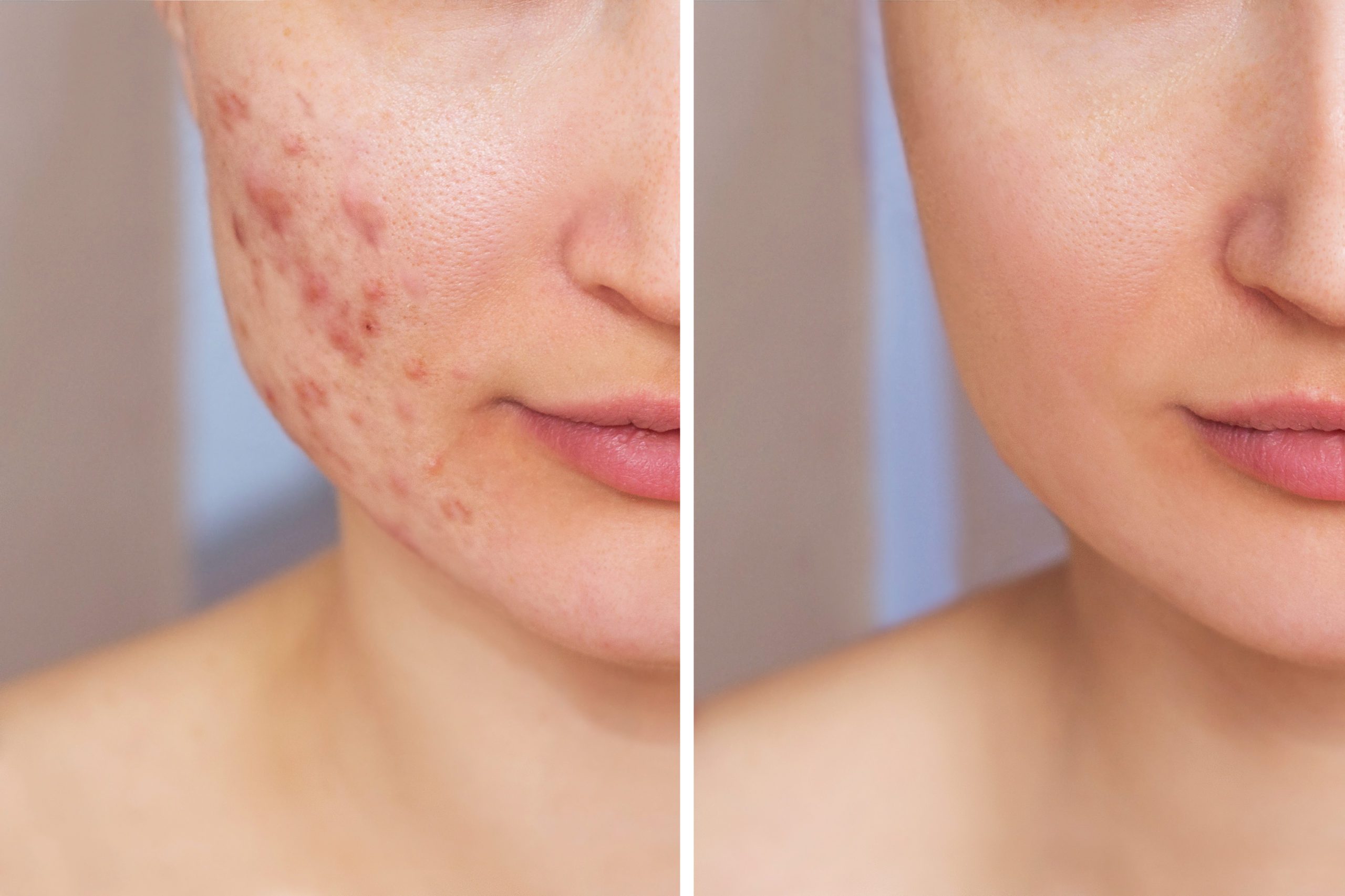 before and after acne treatment