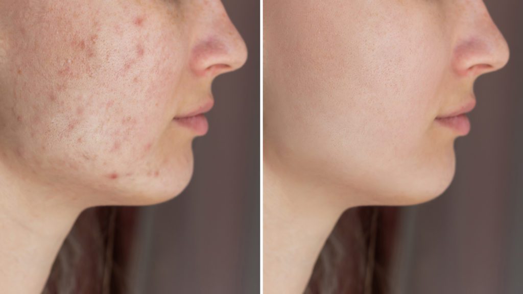 healed acne before and after
