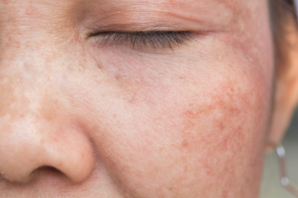 woman with freckles and wrinkles