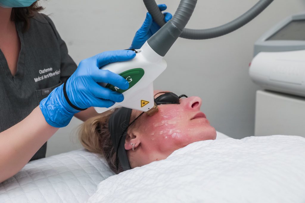 closeup of woman getting IPL treatment