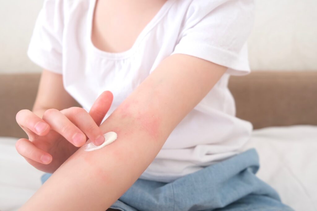 a woman applying cream on her rash