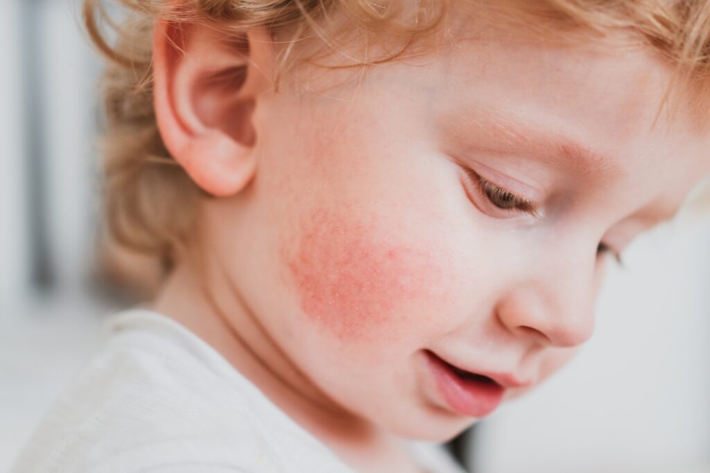 little boy with eczema on his cheek
