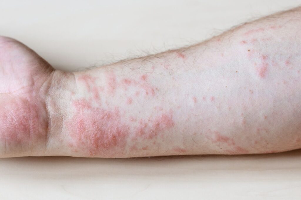 eczema rash on an arm