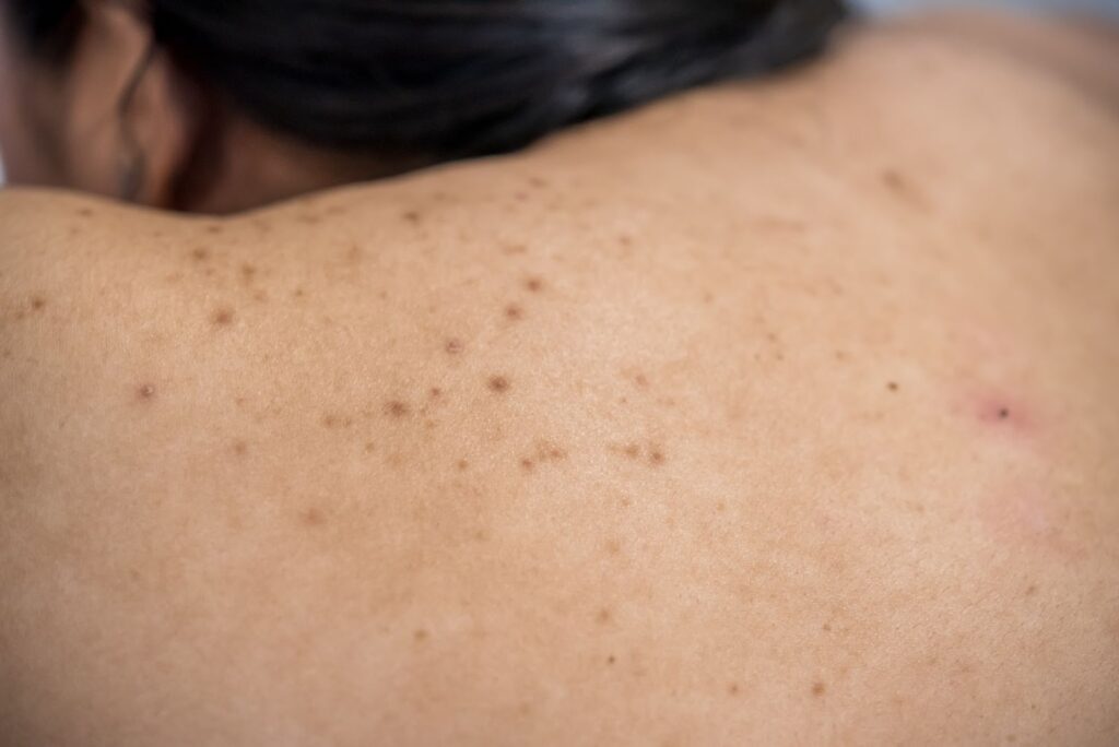 patients back with a lot of blemishes