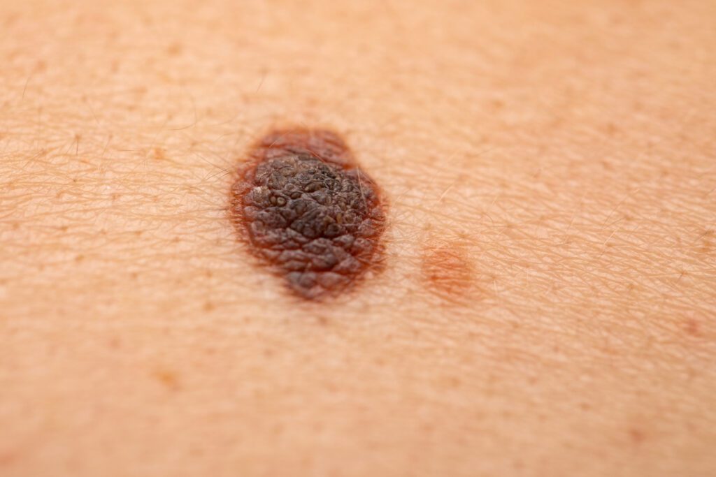 close up of a melanoma