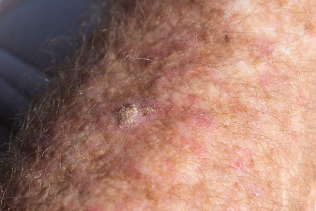 squamous cell carcinoma