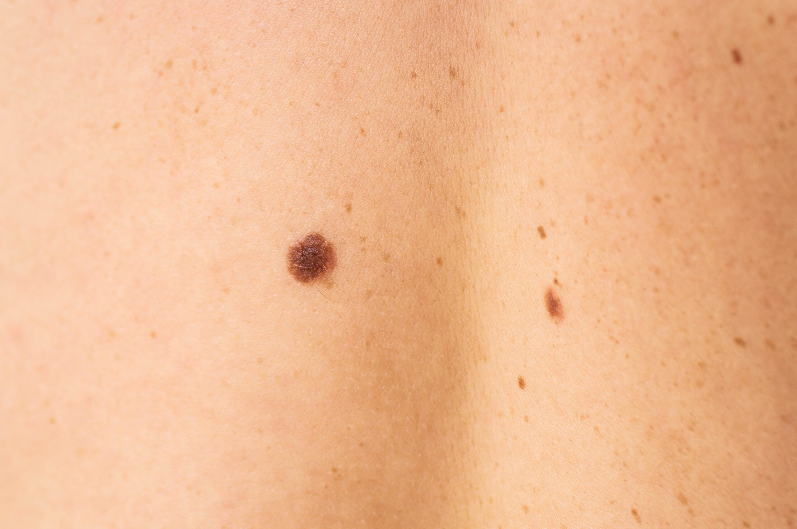 Close up detail of the bare skin on a man back with scattered moles and freckles.