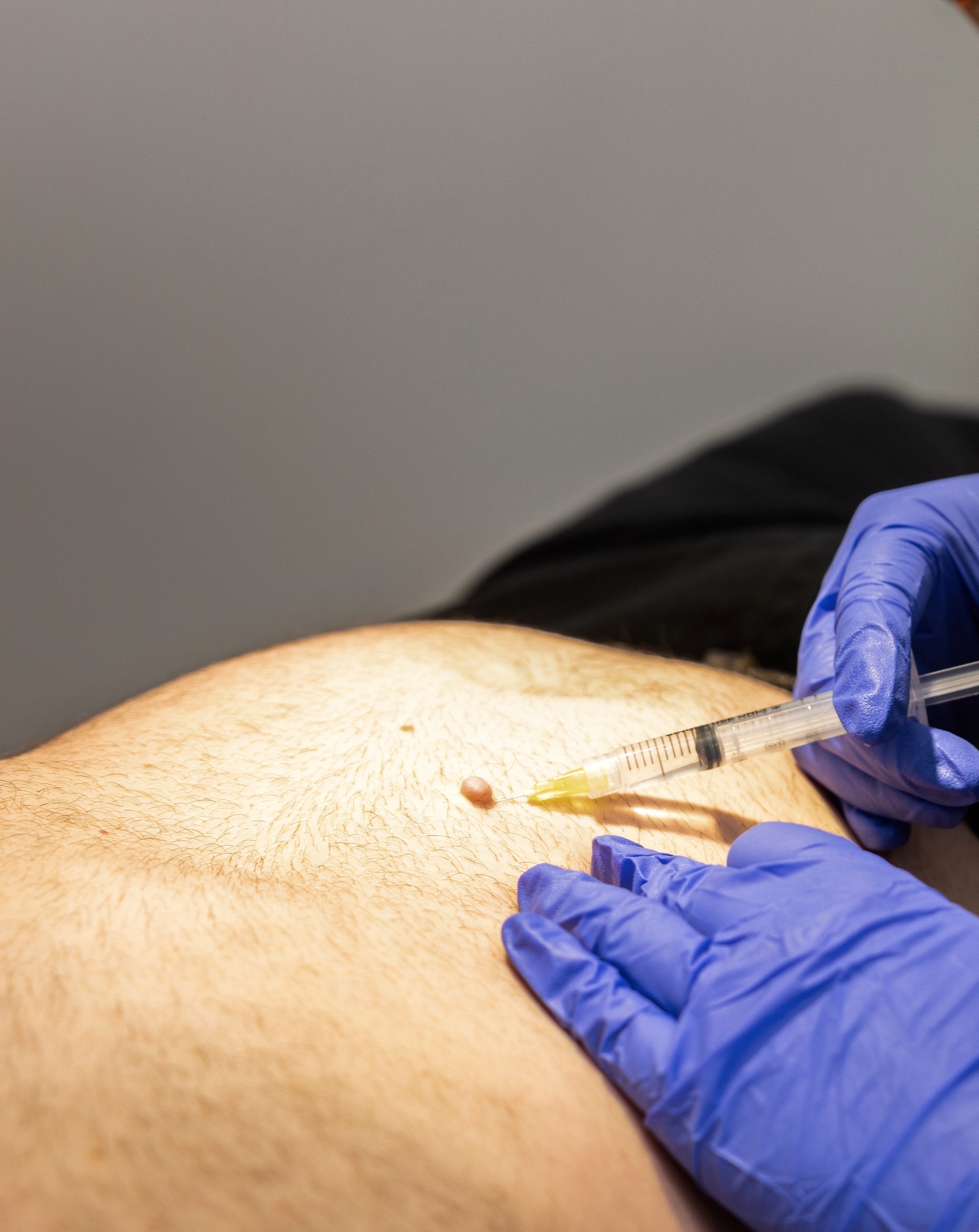 mole removal