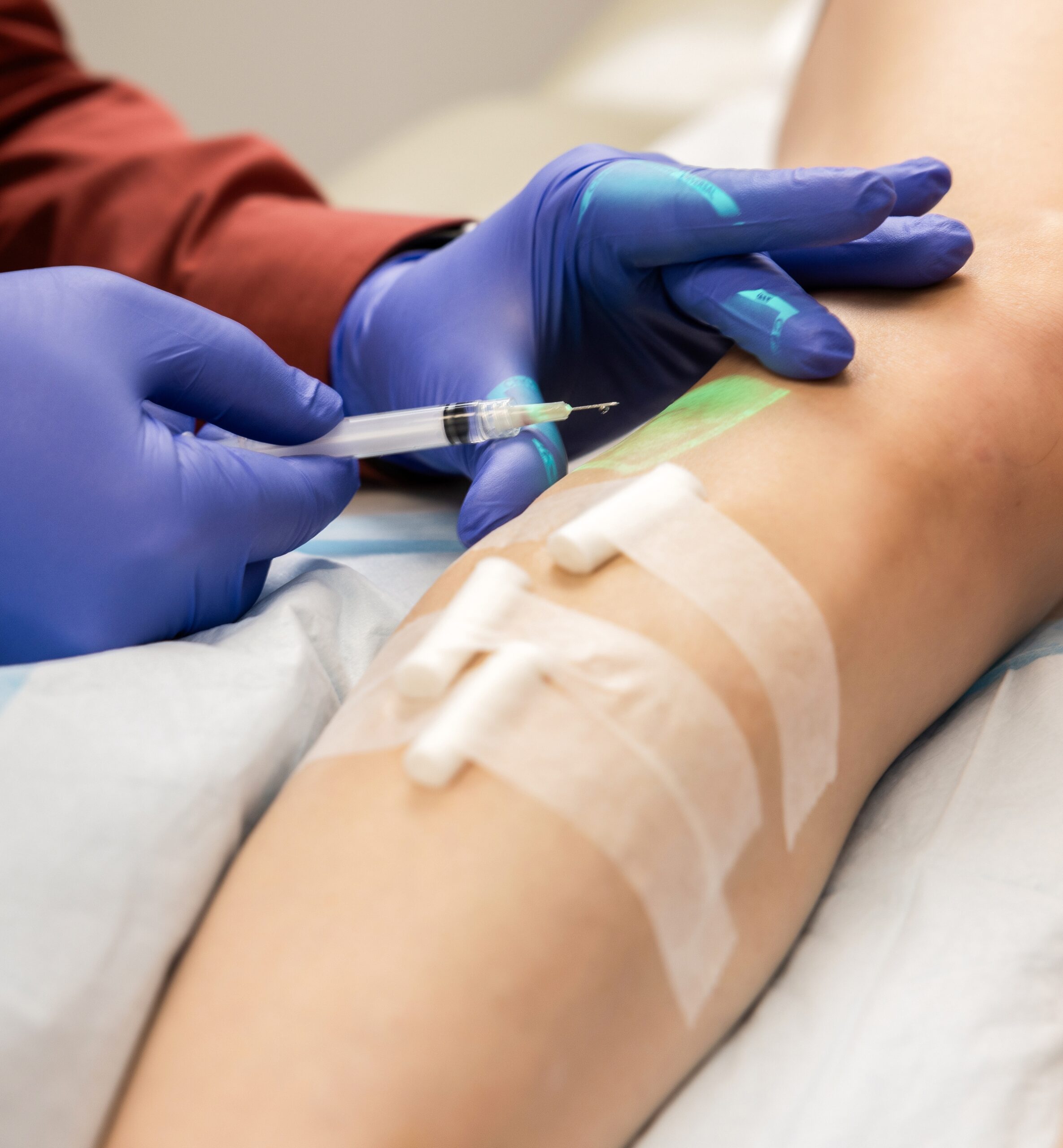 Sclero vein therapy 2-cropped