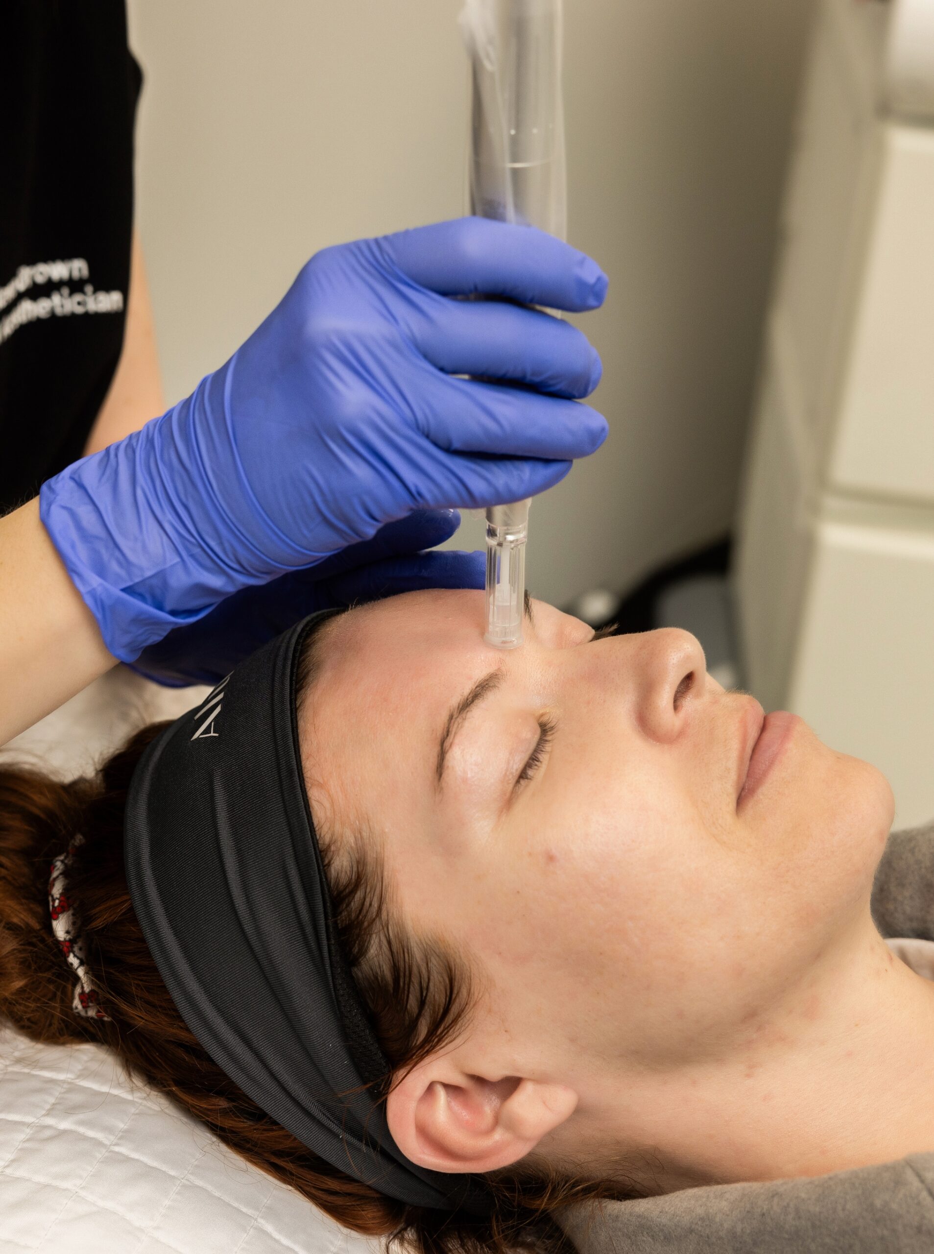 Microneedling-cropped