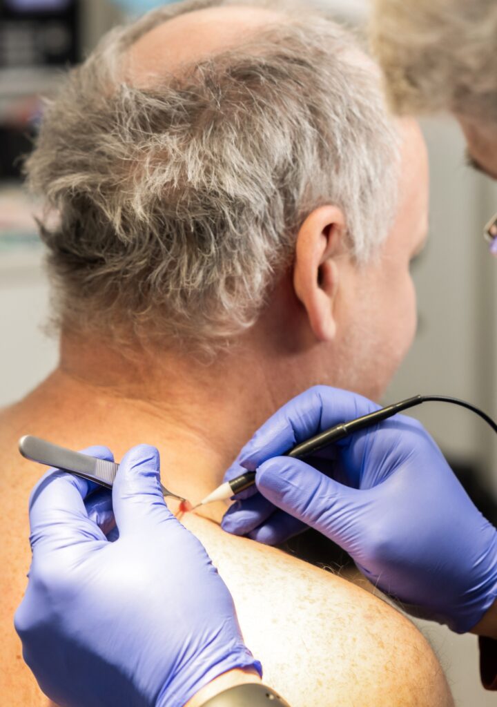 Mole Removal - cropped