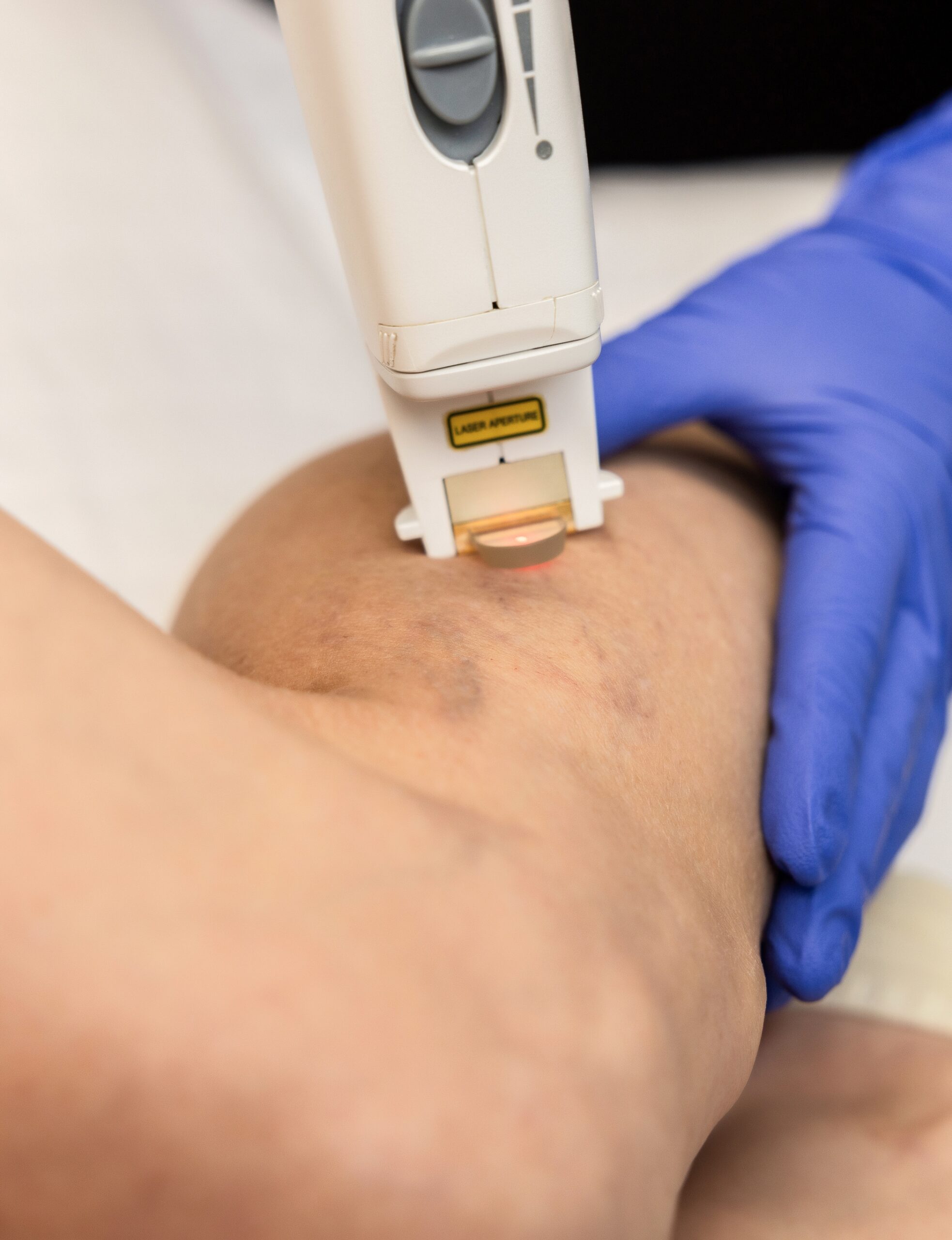 1064 leg veins (1)