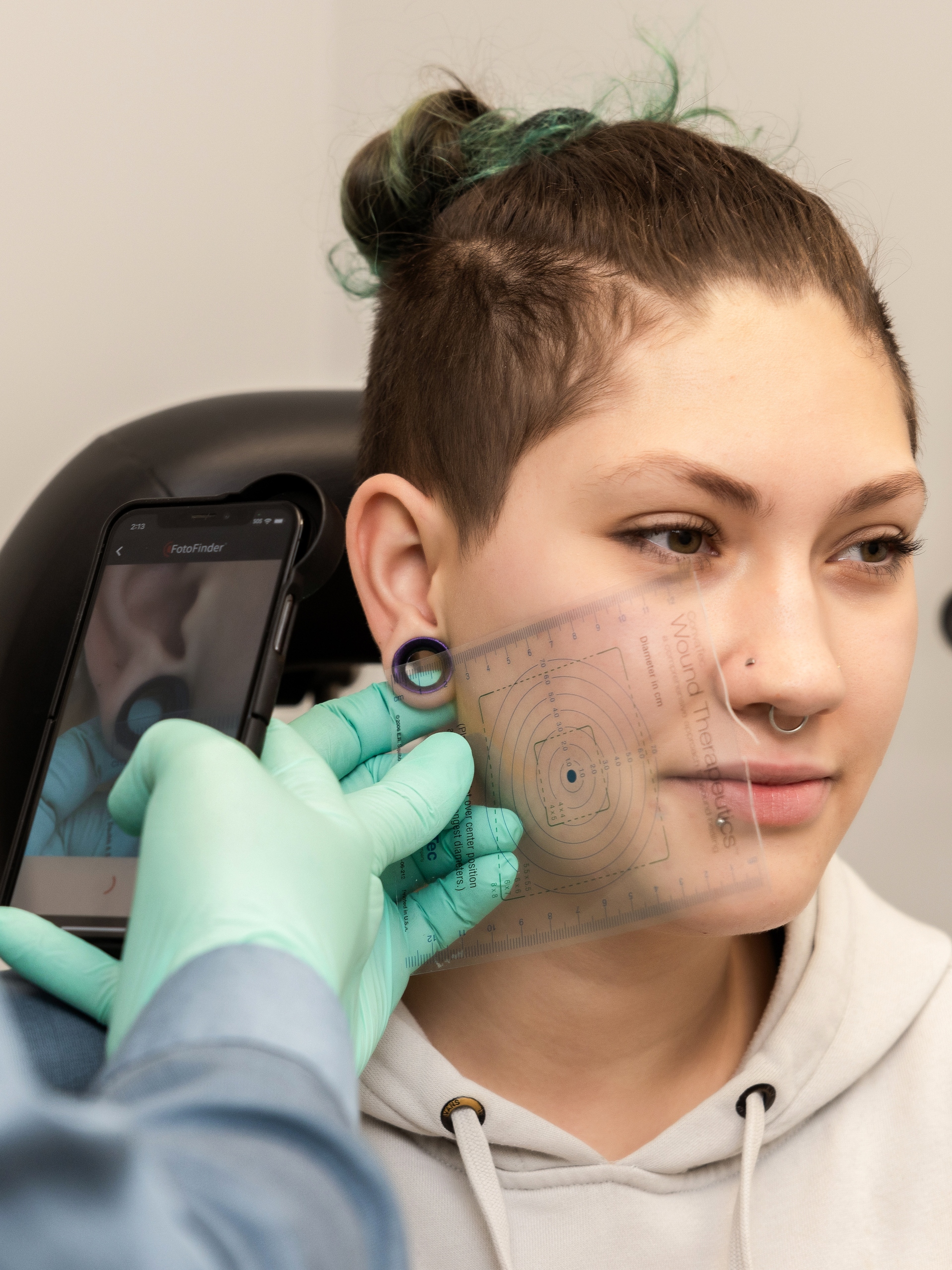 earlobe reconstruction 1-scaled