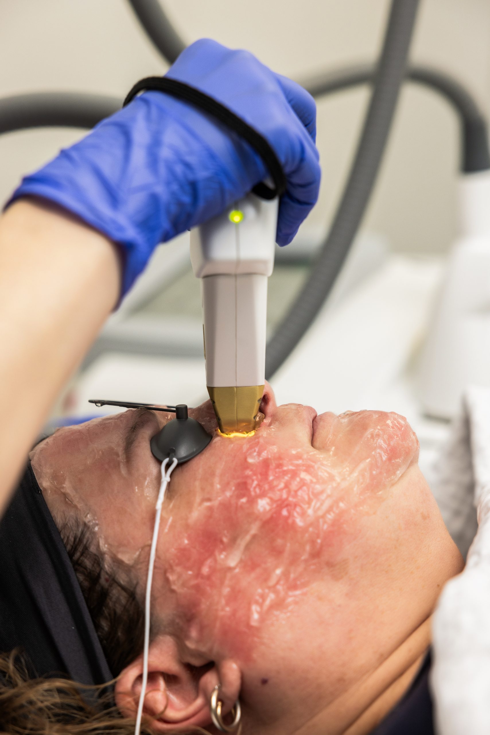 IPL Rosacea
