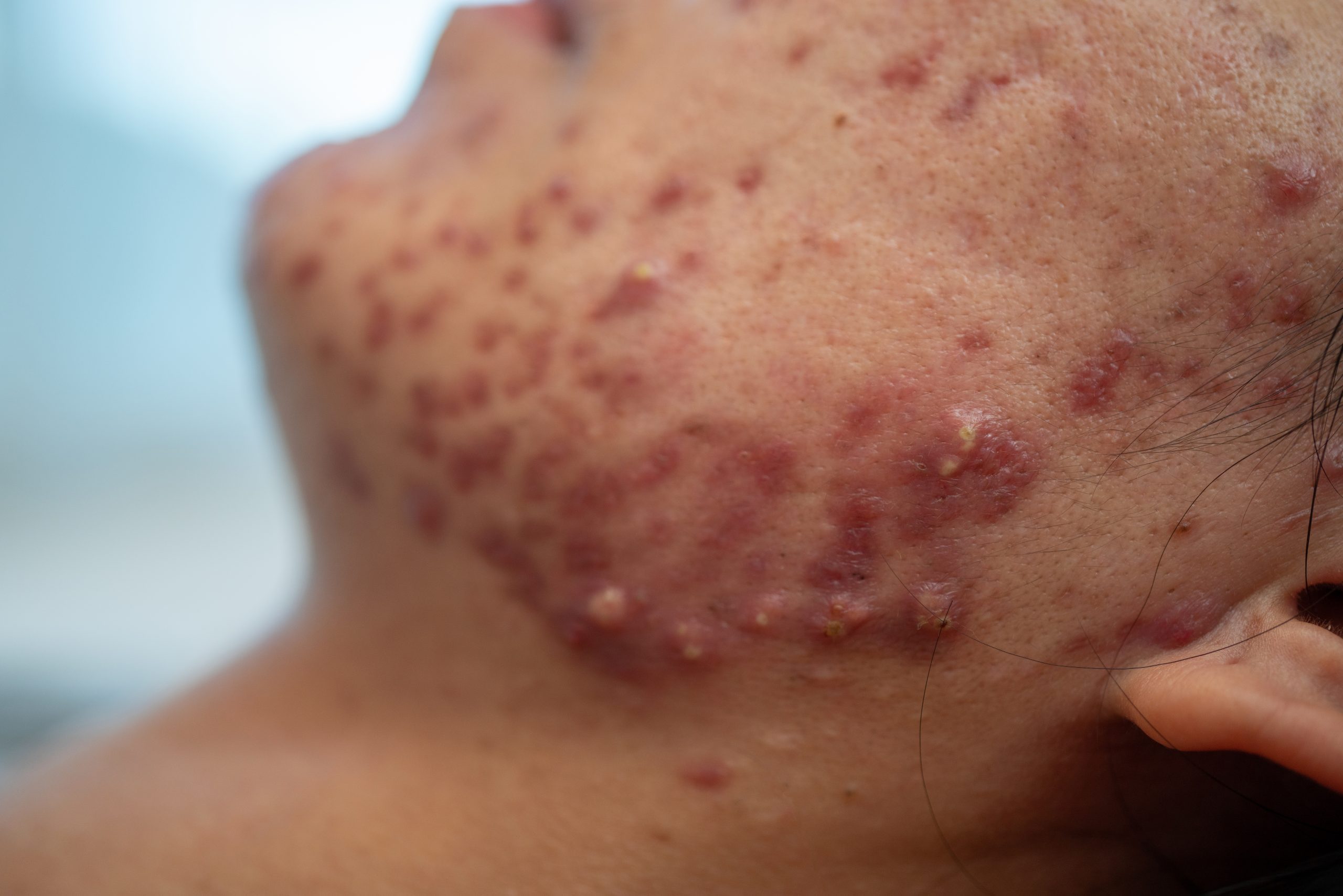 Acne on face because the disorders of sebaceous glands productions.  Acne or a Cosmetic Allergy. Hormonal changes and Foods Cause Symptoms of Skin Allergies